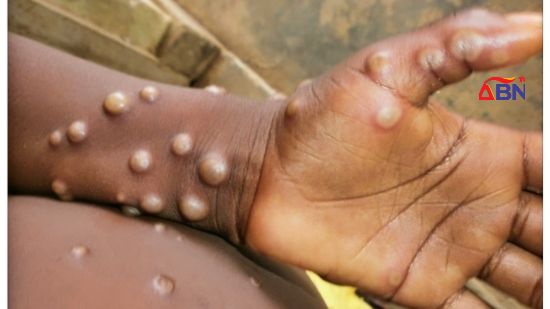 Gombe Confirms 3 Cases Of Monkeypox