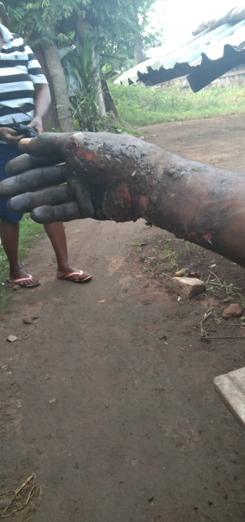 Special Adviser to the Cross River State Governor allegedly burns his subordinates after he had a dream that they betrayed him (photos)