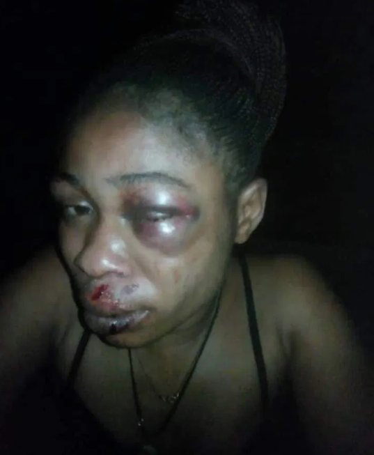 Woman hospitalized after she was allegedly brutalized by her husband for refusing to abort her 3-month-old pregnancy