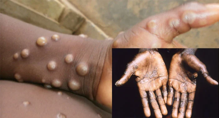Abia Records Three Cases Of Monkeypox As Govt Cautions Residents