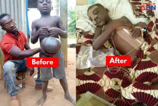 Dan Okeke Sponsors Umbilical Hernia Surgery Of 6-Year-Old Patient (Photos) Dan Okeke Sponsors Umbilical Hernia Surgery Of 6-Year-Old Patient (Photos)