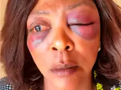 NSCDC Officials Leave Woman Partially Blind After Brutal Attack In Plateau