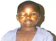 Hoodlums Remove 12-Year-Old Boy’s Eye In Bauchi