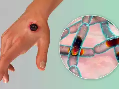 Nigeria Records First Anthrax Case Nigeria Records First Anthrax Case