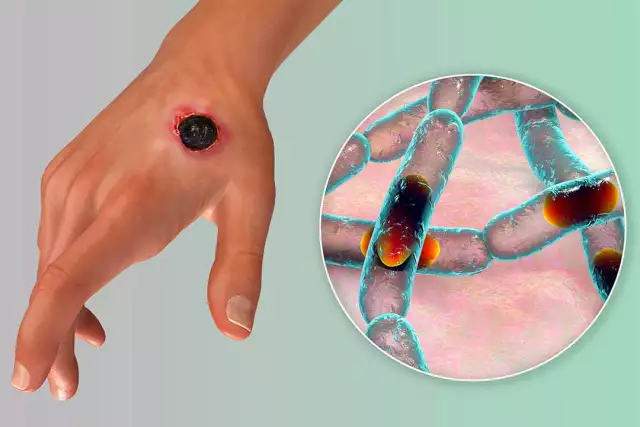 Nigeria Records First Anthrax Case Nigeria Records First Anthrax Case