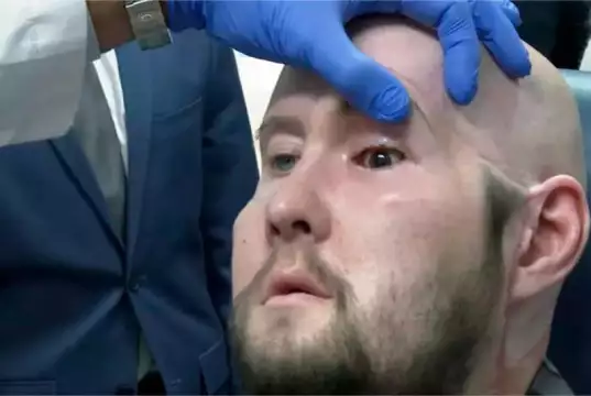 US Surgeons Successfully Perform World’s First Human Eye Transplant US Surgeons Successfully Perform World's First Human Eye Transplant