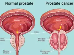 Medical Experts Warn Against Prostate Cancer, Call For Lifestyle, Food Check Medical Experts Warn Against Prostate Cancer, Call For Lifestyle, Food Check