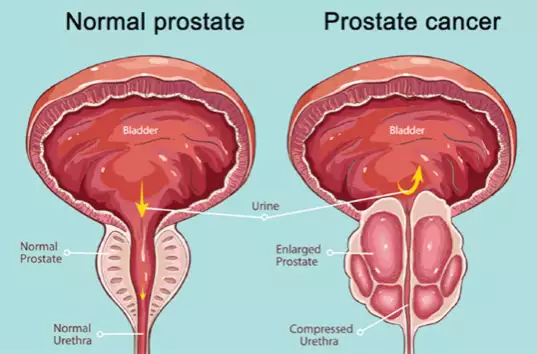 Medical Experts Warn Against Prostate Cancer, Call For Lifestyle, Food Check Medical Experts Warn Against Prostate Cancer, Call For Lifestyle, Food Check