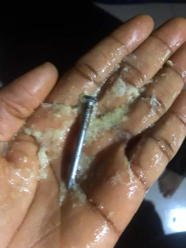 5-Month-Old Baby Vomits Swallowed Nail, Mother Expresses Gratitude (Photo) 5-Month-Old Baby Vomits Swallowed Nail, Mother Expresses Gratitude (Photo)