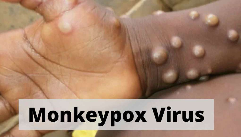 Fears As Abia Confirms First Monkeypox Case