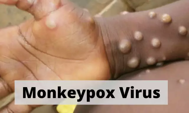 Fears As Abia Confirms First Monkeypox Case Fears As Abia Confirms First Monkeypox Case