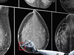 AI Set To Revolutionize Breast Cancer Detection For At-Risk Women AI Set To Revolutionize Breast Cancer Detection For At-Risk Women