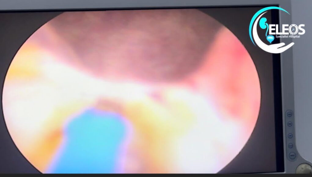 Hope For Men Battling Enlarged Prostate As New Laser Technology Arrives Nigeria