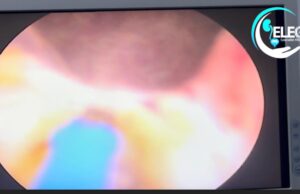 Hope For Men Battling Enlarged Prostate As New Laser Technology Arrives Nigeria Hope For Men Battling Enlarged Prostate As New Laser Technology Arrives Nigeria