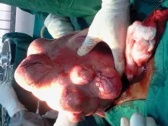 Fibroid Without The Knife: How Sound Waves Are Giving Women A New Treatment Option Fibroid Without The Knife: How Sound Waves Are Giving Women A New Treatment Option