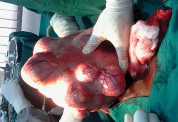 Fibroid Without The Knife: How Sound Waves Are Giving Women A New Treatment Option Fibroid Without The Knife: How Sound Waves Are Giving Women A New Treatment Option