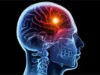 ‘One In 4 Nigerian Stroke Patients Under 50’ ‘One In 4 Nigerian Stroke Patients Under 50’