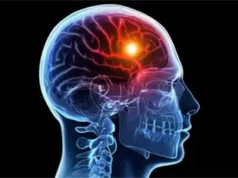 ‘One In 4 Nigerian Stroke Patients Under 50’ ‘One In 4 Nigerian Stroke Patients Under 50’